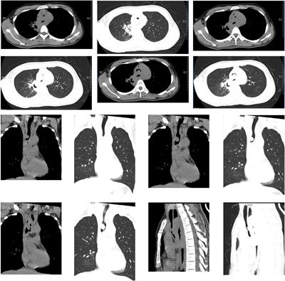 Intervention to severe lower trachea obstruction supported by extracorporeal membrane oxygenation in a human immunodeficiency virus patient: A case report and literature review